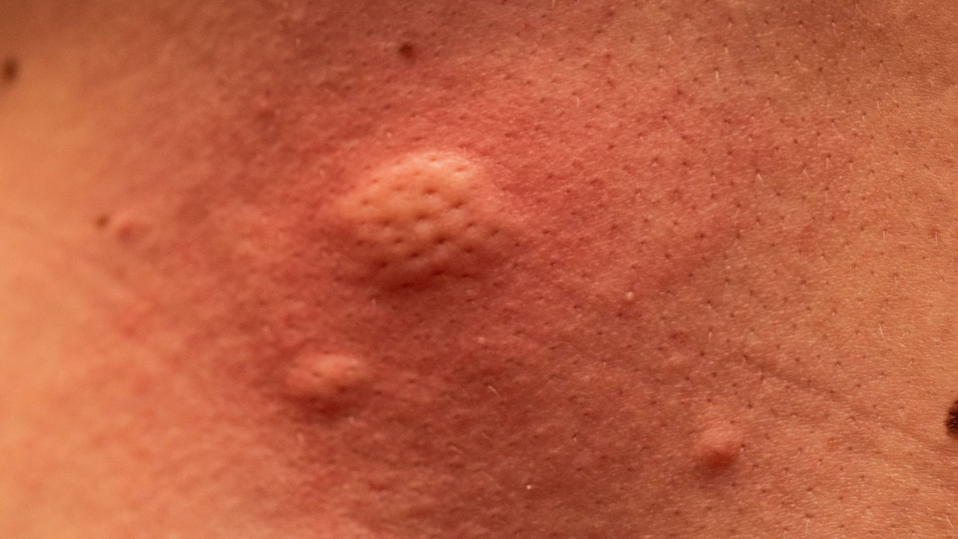 Mückenstiche können höllisch jucken - und eine einzelne Mücke im Schlafzimmer kann viel anrichten!