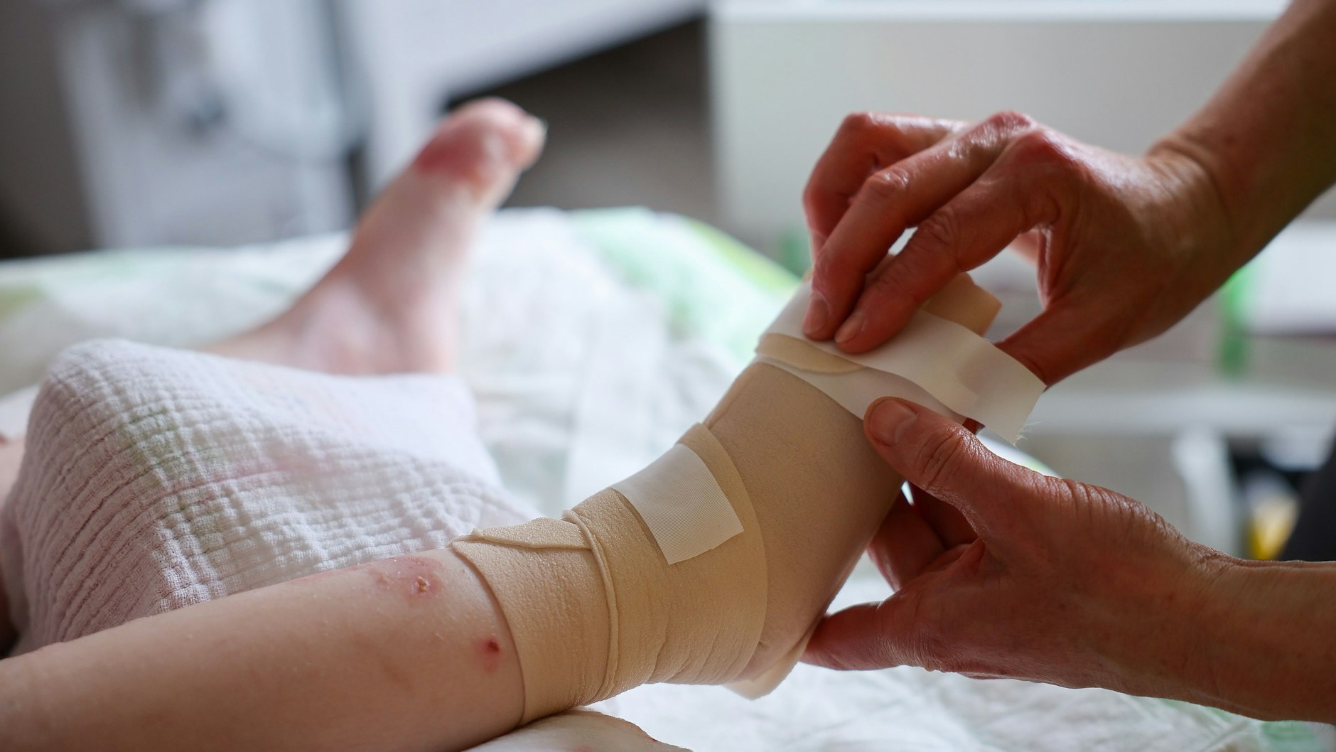 Käthe unterzieht sich dem täglichen, zweistündigen Verbandswechsel. Die Vierjährige leidet an der unheilbaren Epidermolysis bullosa.