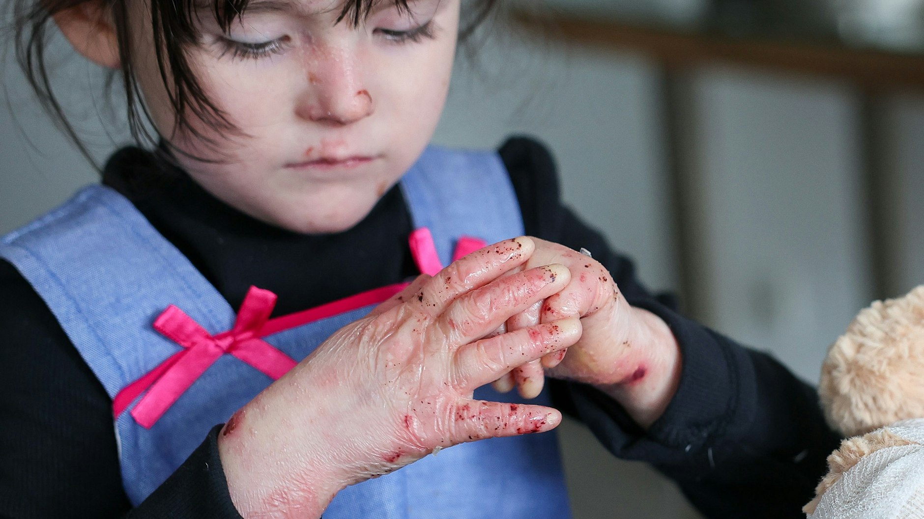 Die kleine Käthe leidet an der sehr seltenen Schmetterlingskrankheit. Schon kleinste Verletzungen, Reibungen oder Druck führen zu Blasen und offenen Wunden. 