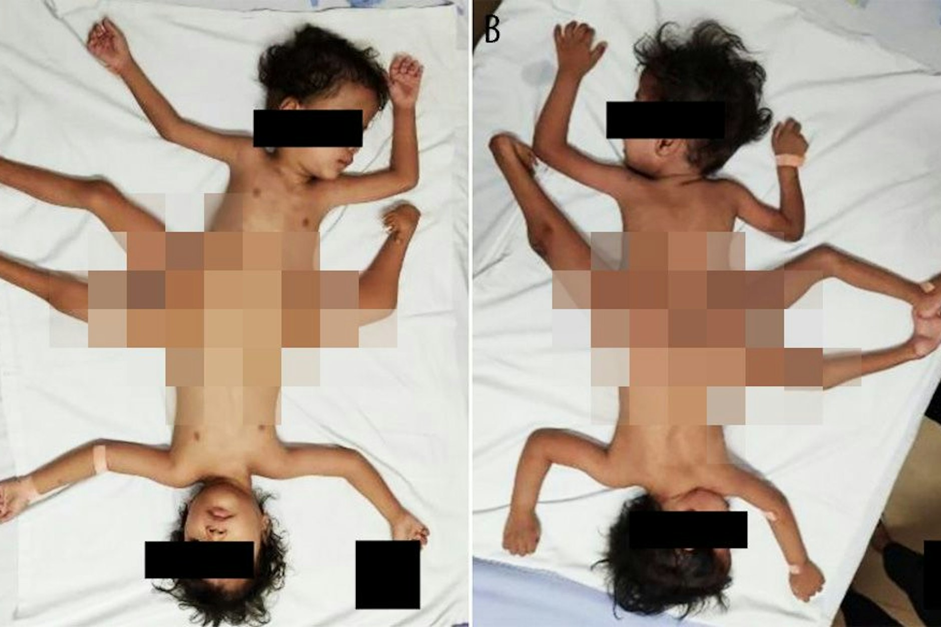 Unglaublicher Fall in Indonesien: Diese beiden Jungen kamen am Becken zusammengewachsen zur Welt.