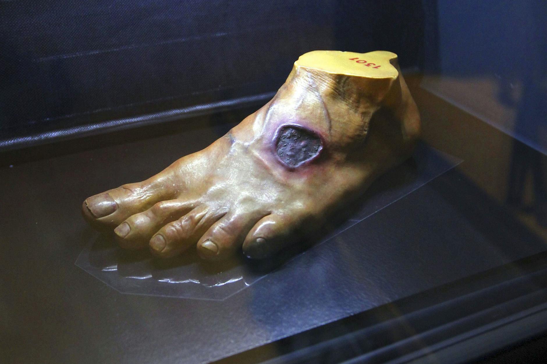 Ein mit „Schwarzer Pest“ befallener Fuß wird auf eine Ausstellung in Kassel gezeigt.