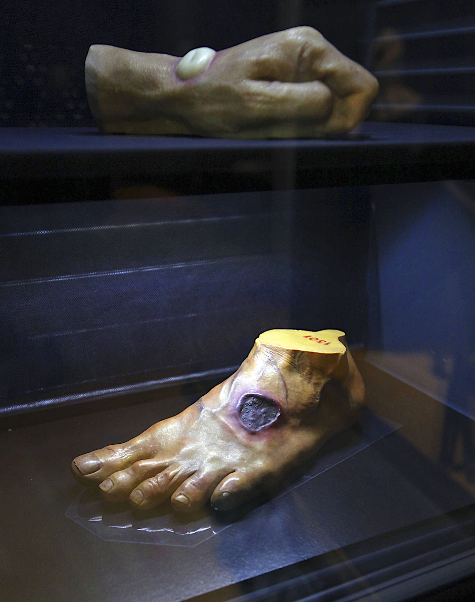 Ein mit „Schwarzer Pest“ befallener Fuß wird auf eine Ausstellung in Kassel gezeigt.