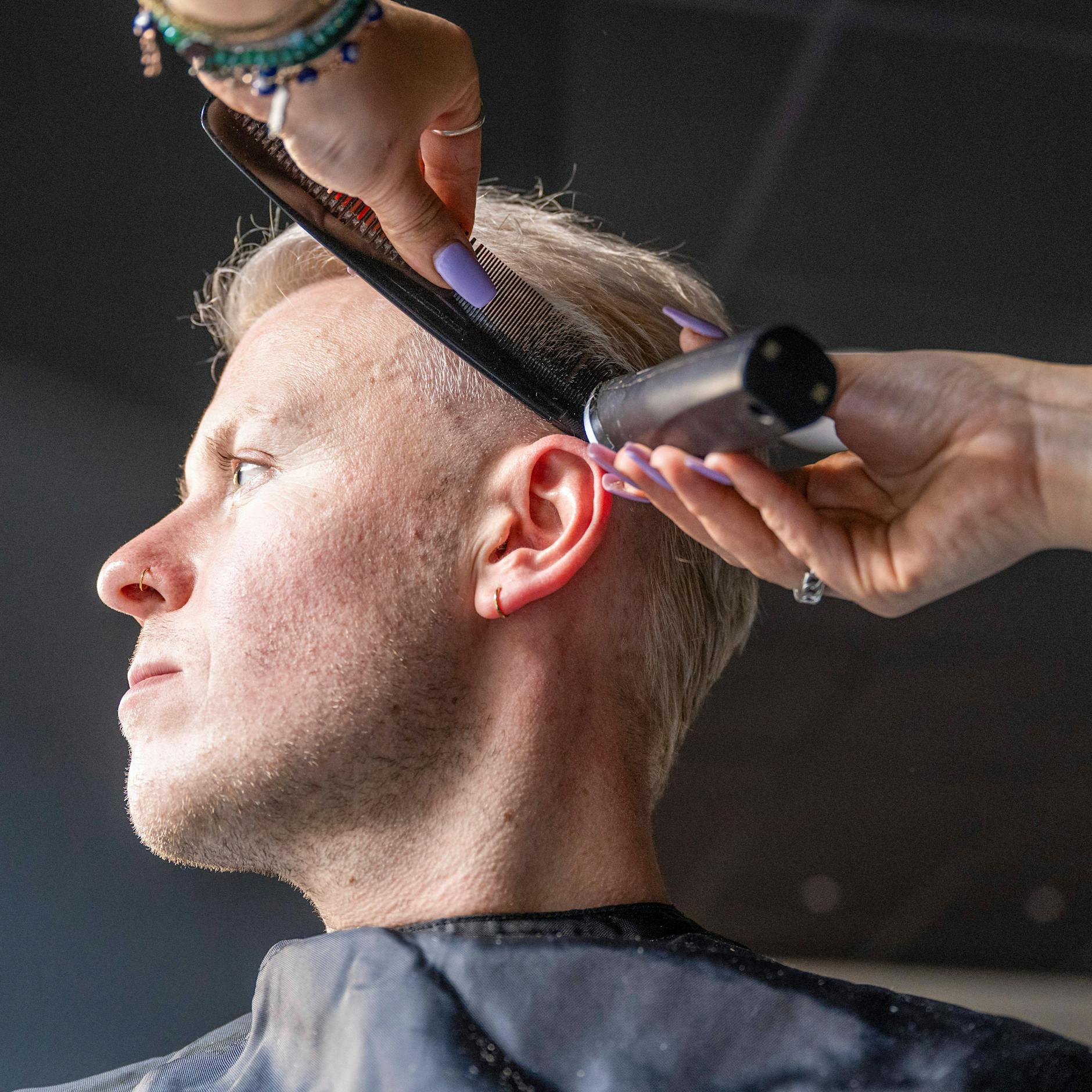 Ekel-Alarm: Eitriger Hautpilz bei Männern – wegen Barbershops?