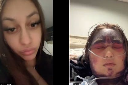 Geschwollenes Gesicht, blutunterlaufene Augen: Sind das die Folgen einer körperlichen Überreaktion auf eine Impfung?