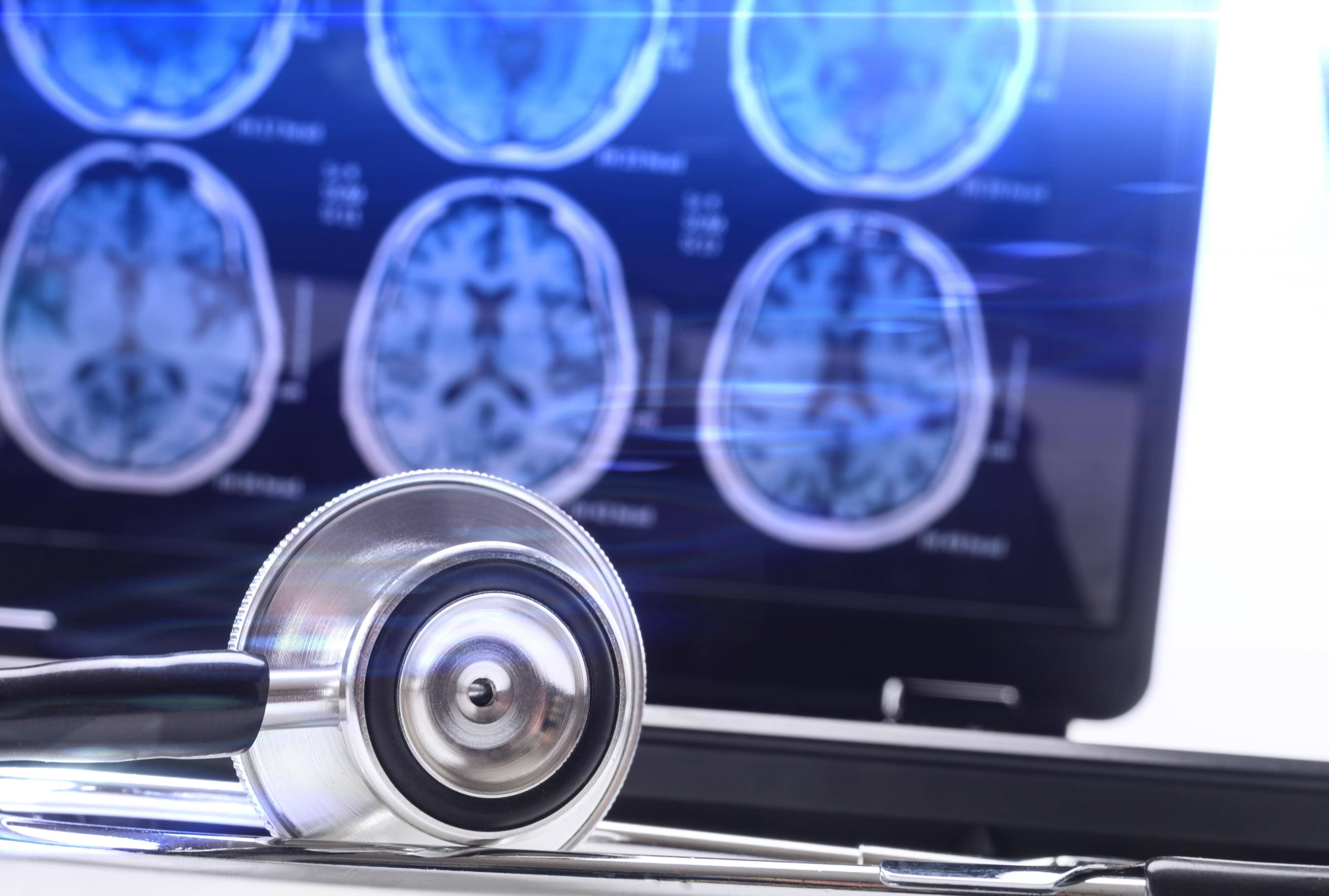 Neue Schock-Studie: Gehirn altert durch Corona-Infektion um 20 Jahre