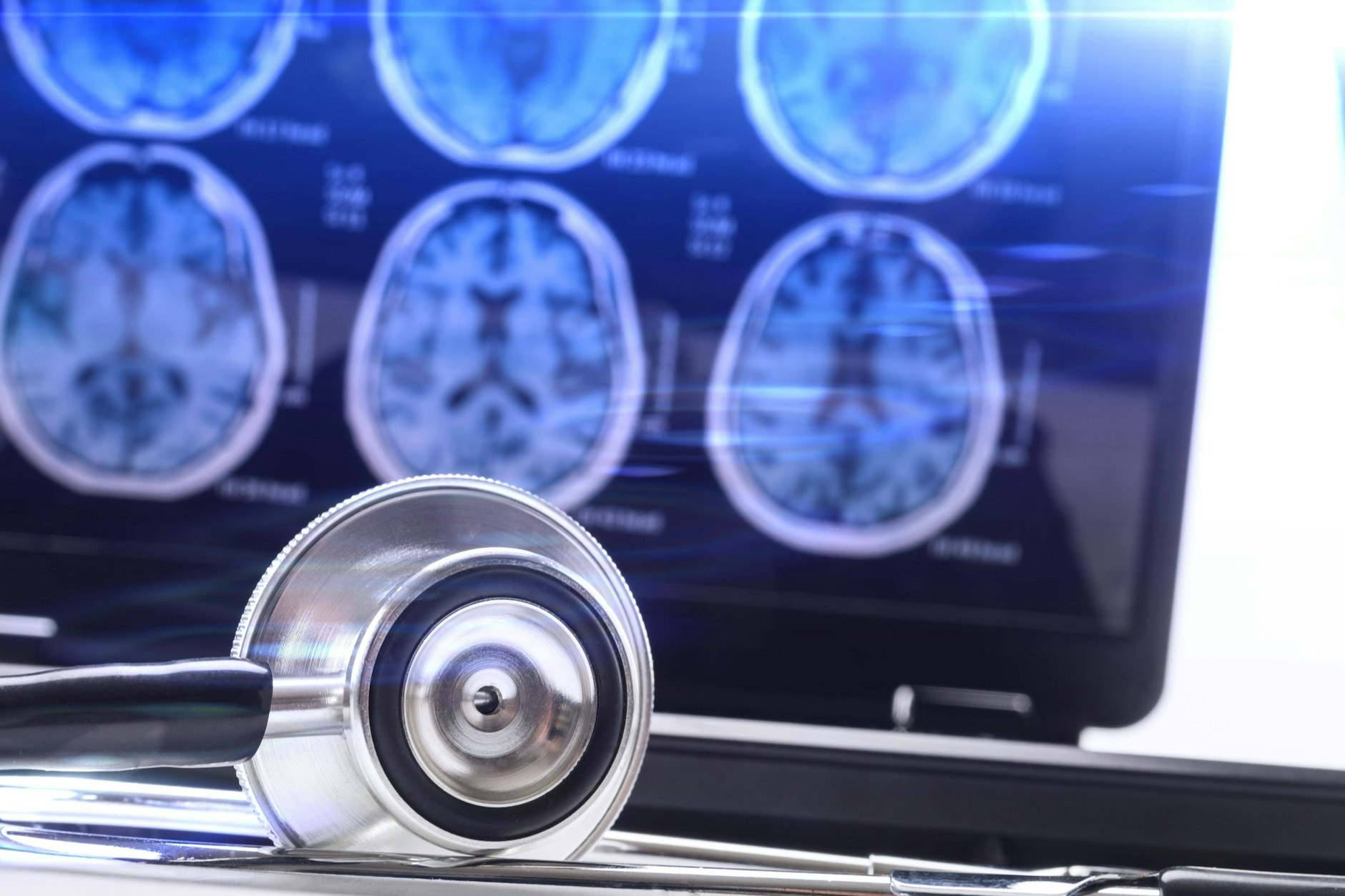 Forscher untersuchten die Auswirkungen einer Infektion mit dem Coronavirus auf das Gehirn.