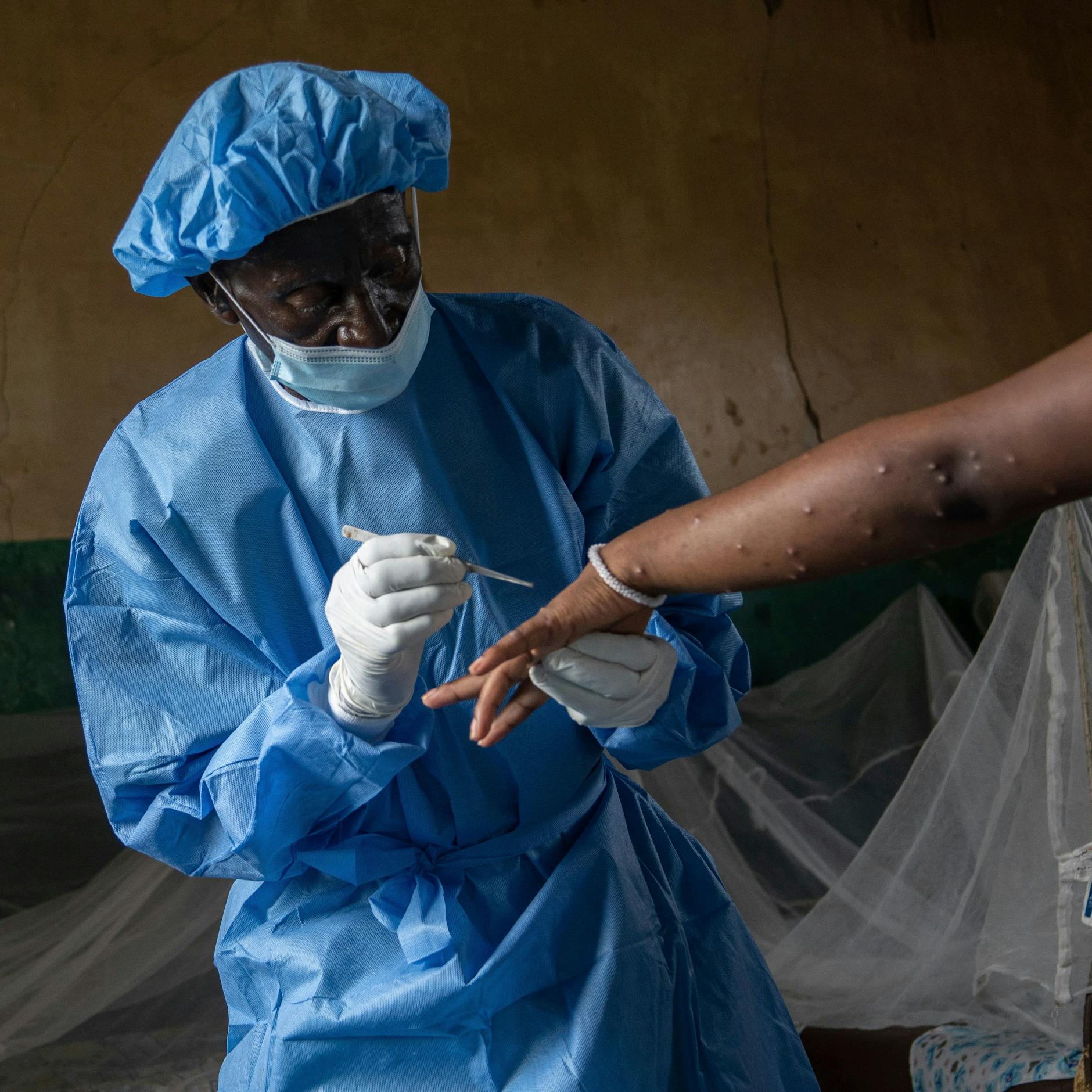 Image - Erster Mpox-Fall in Deutschland: Warum dürfen wir nicht mehr Affenpocken sagen?