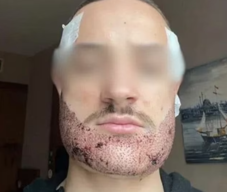 Makler verpfuscht Haartransplantation in Türkei – Opfer übel entstellt