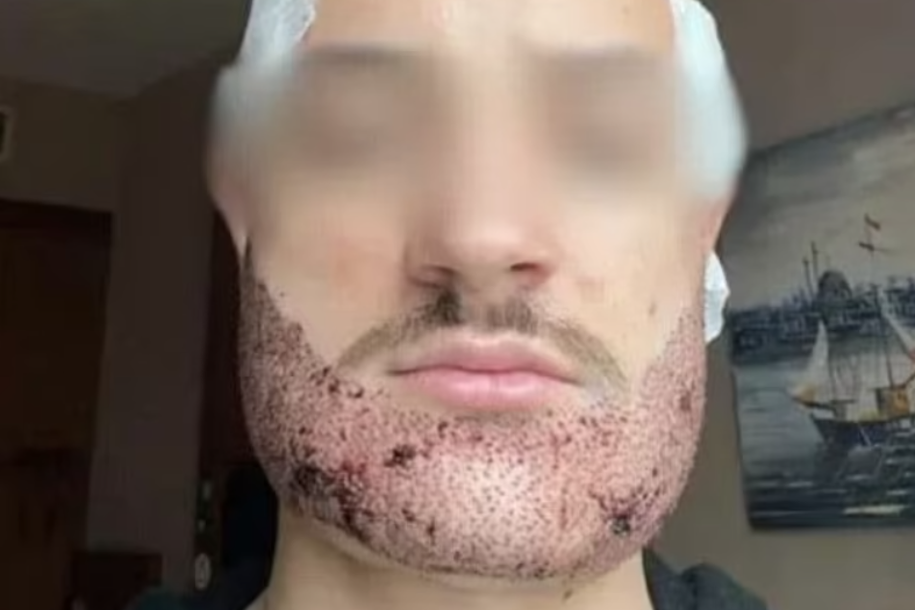 Mathieu Vigier Latour wurde durch die Haartransplantation in der Türkei dauerhaft im Gesicht entstellt. Der angebliche Arzt war in Wirklichkeit Immobilienmakler.