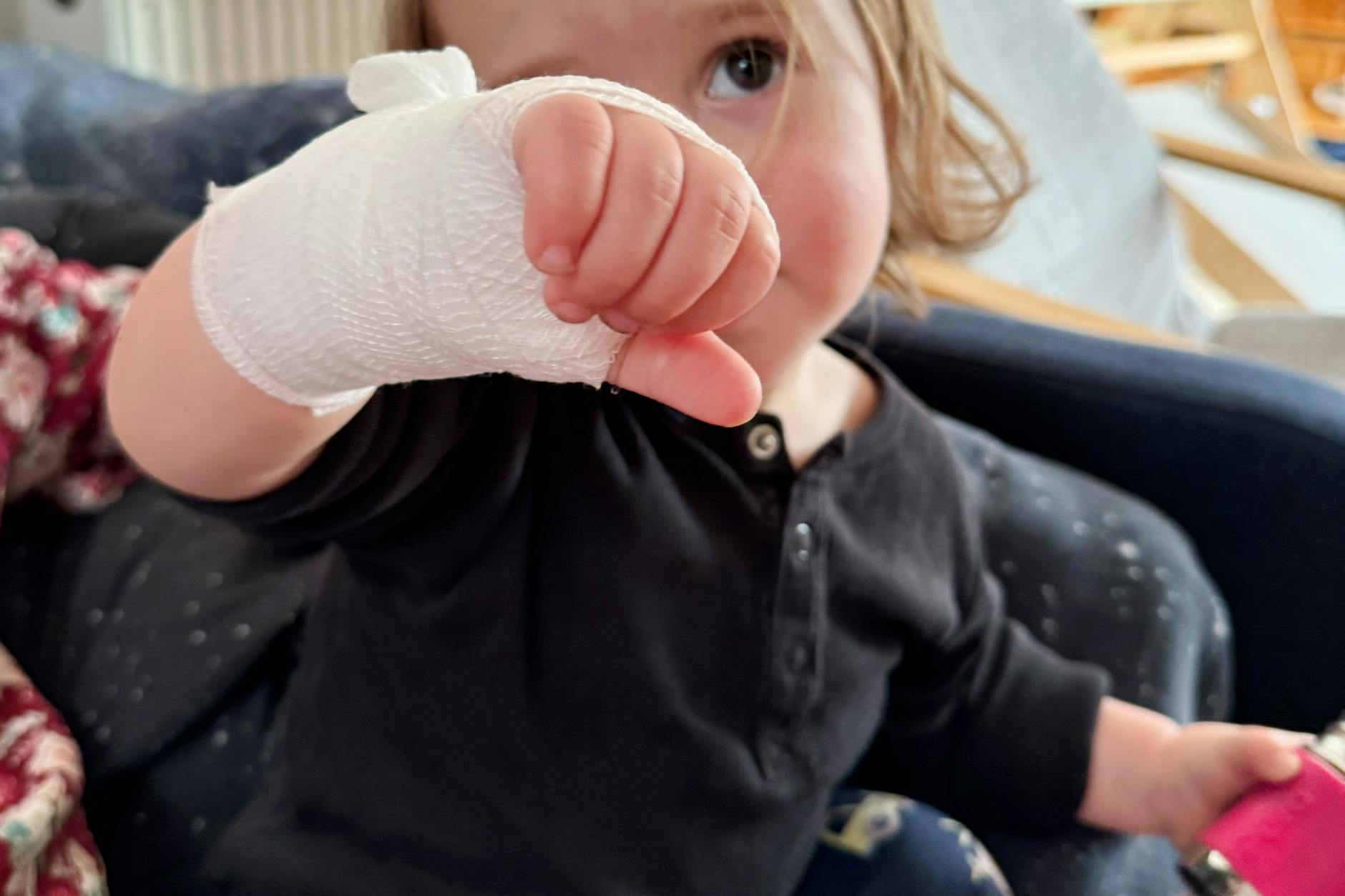 Verbrannt am heißen Pfannenrand: Ein Wundverband schützt die verletzte Stelle.