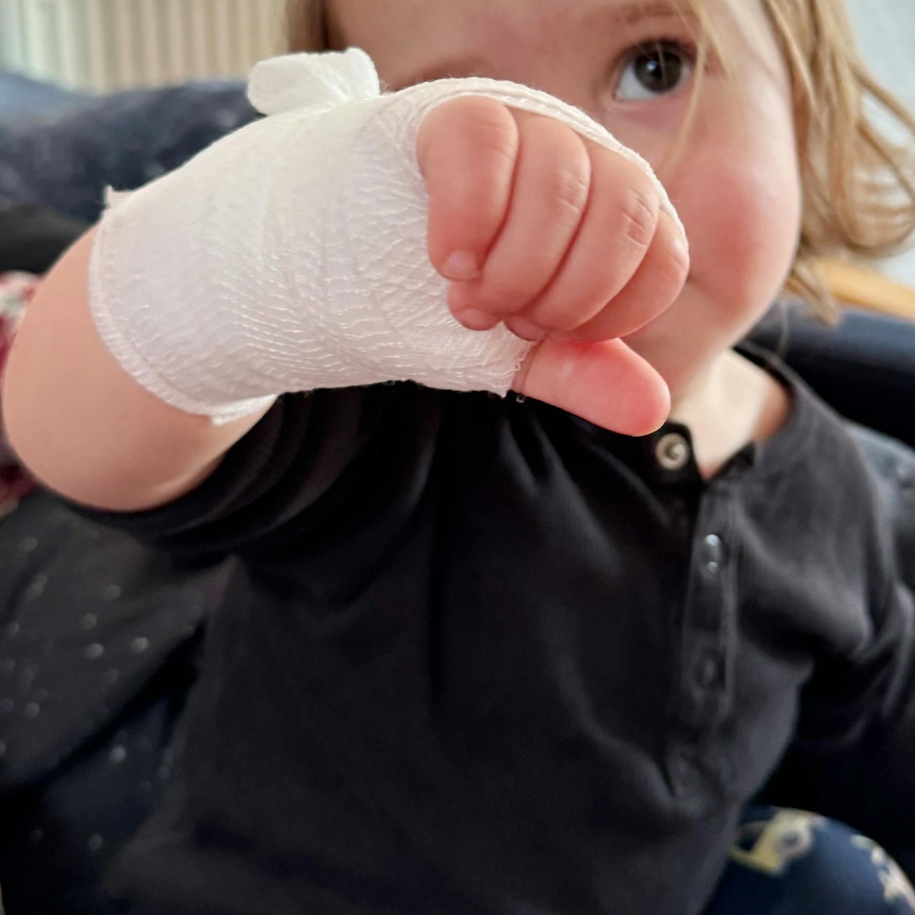 Mein Kind hat sich verbrannt! Erste Hilfe bei Verbrennungen