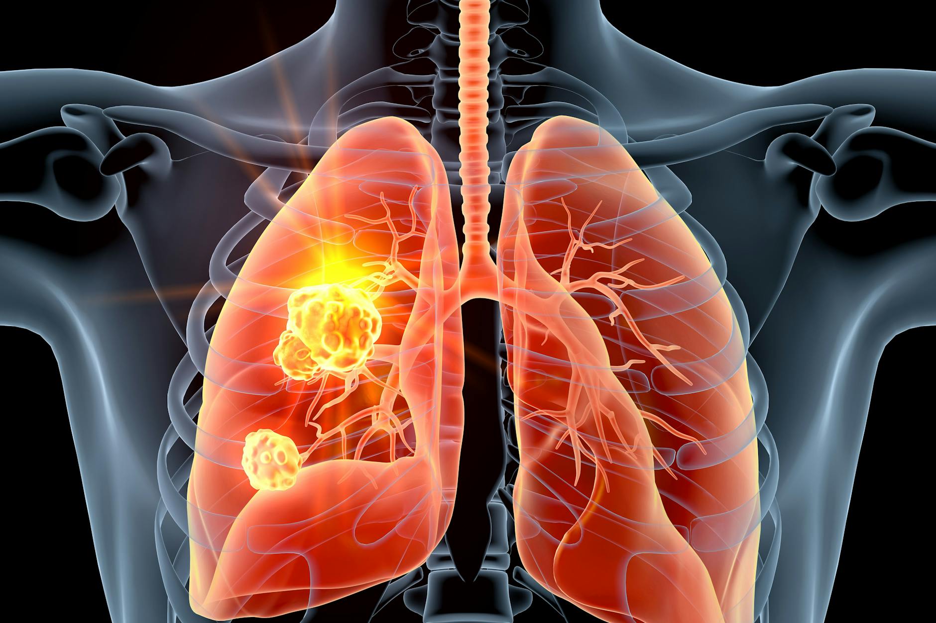 Rund 57.500 Menschen erkranken in Deutschland jährlich an Lungenkrebs.