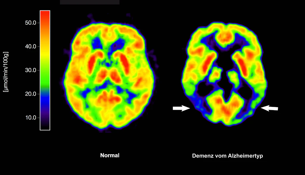 Überraschende Studie: Häufiges Virus könnte Alzheimer auslösen