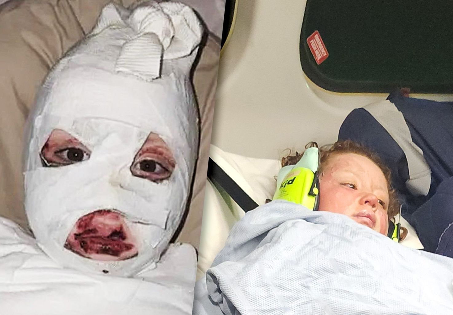 Horror-Verletzungen: Mädchen (8) beinahe verbrannt – wegen Temu-Pulli!