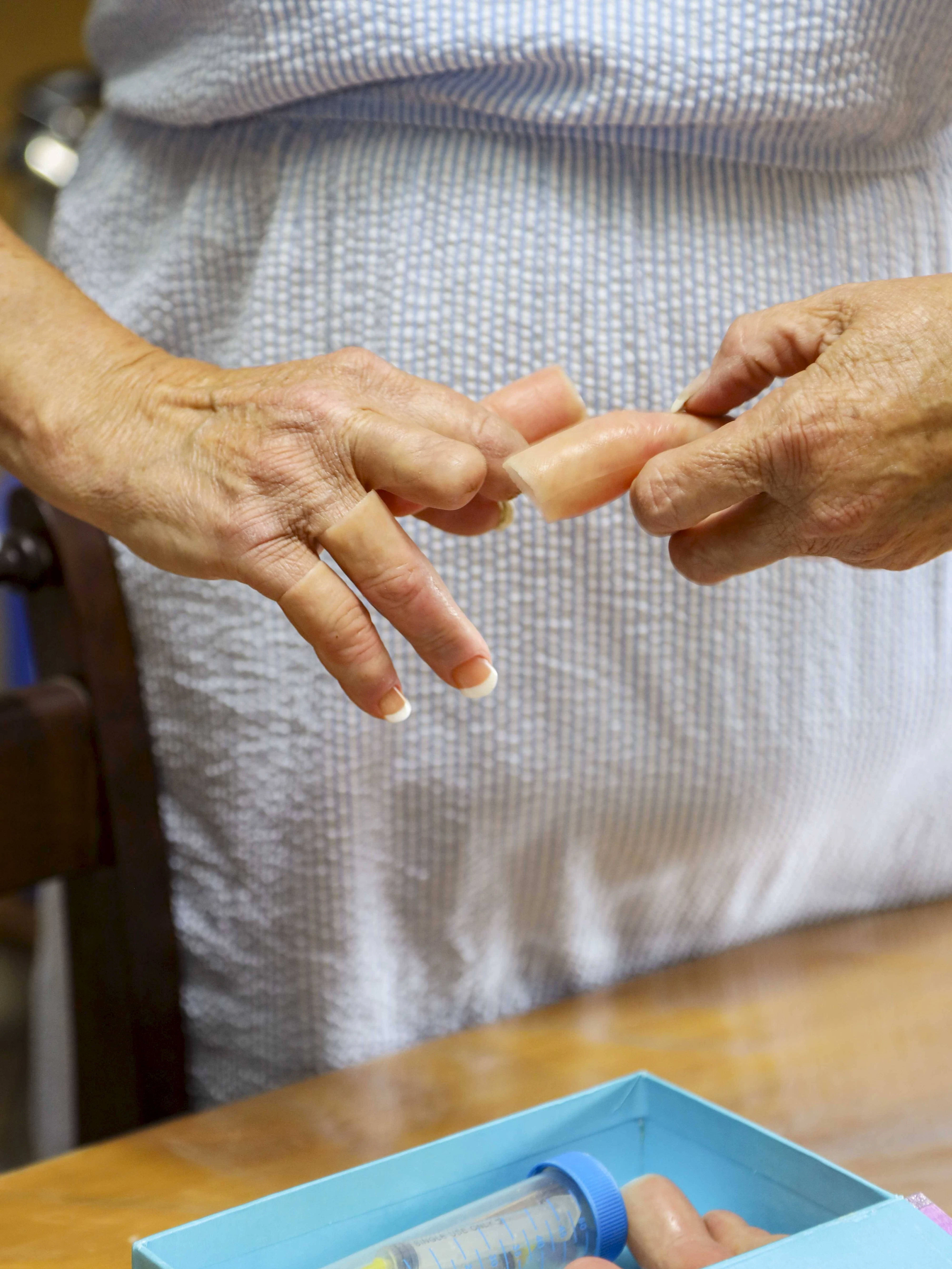 Mit Finger-Prothesen kommt Cathrine Abbott-Coetzee durch den Alltag. 