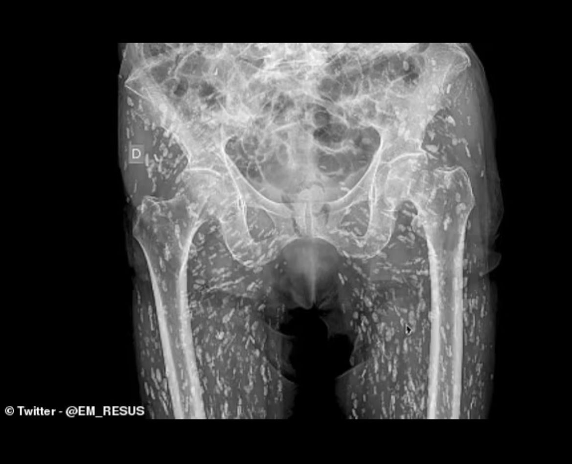 Image - Ekel-Röntgenbild von Bandwurmlarven schockt Mediziner