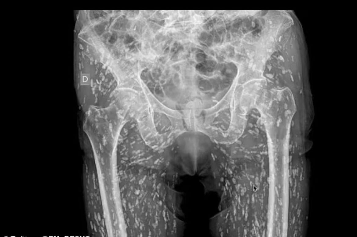 Dieses Röntgenbild zeigt die Bandwurm-Larven erzeugten Mini-Zysten.