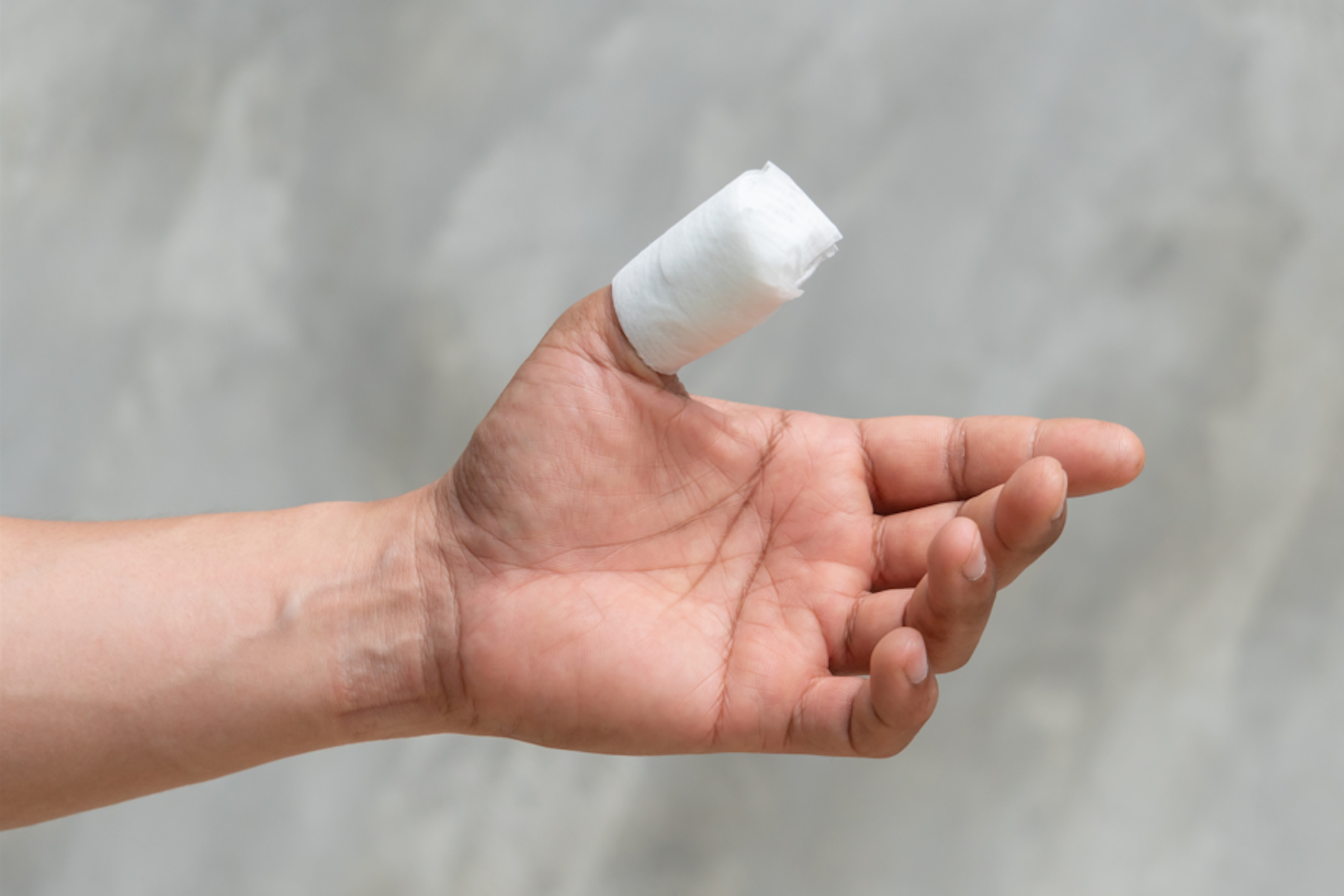 Eine Verbrennung am Daumen hatte für den Amerikaner Max Armstrong schlimme Folgen (Symbolfoto).