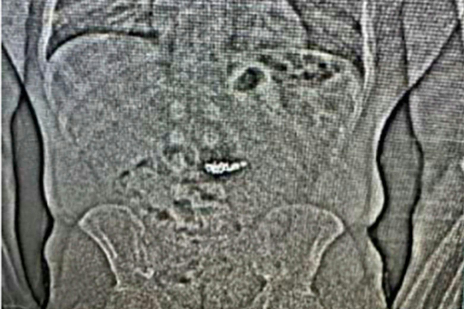 Die Polizei von Orlando veröffentlichte das Röntgenbild des mutmaßlichen Diebes. Es zeigt wahrscheinlich Ohrringe, die der Verdächtige geklaut und verschluckt hat.