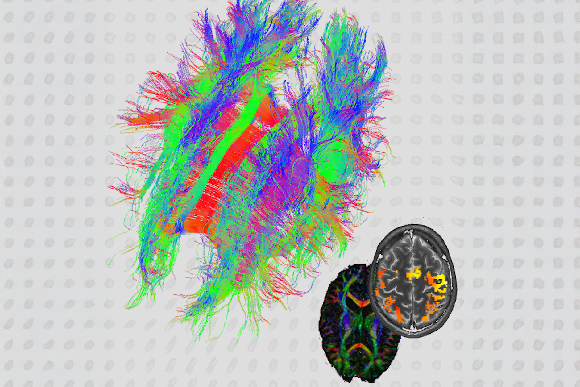 Medizinische Bildverarbeitung: Darstellung von Axonen im menschlichen Gehirn