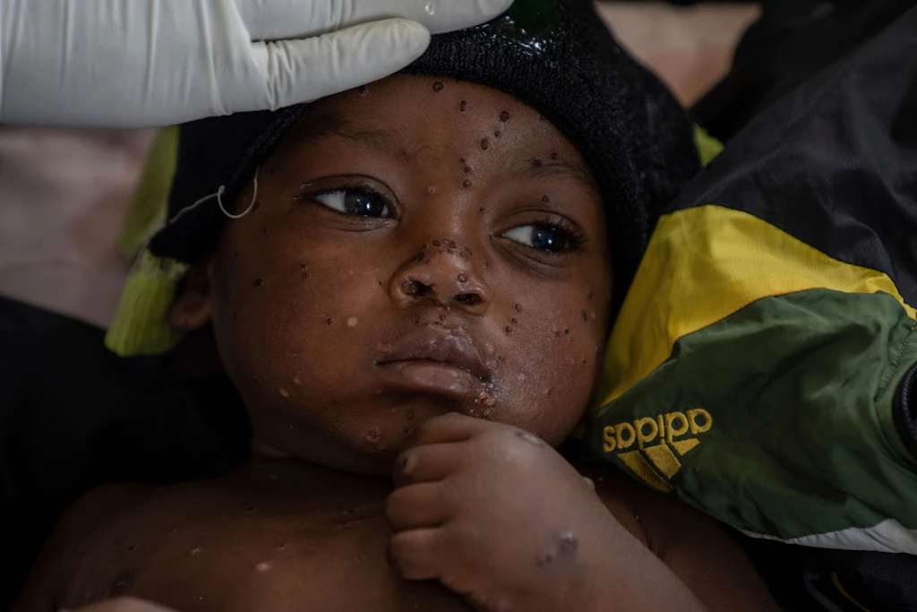 Mpox könnte schlimme Bedrohung werden ++ Berlin stark betroffen!