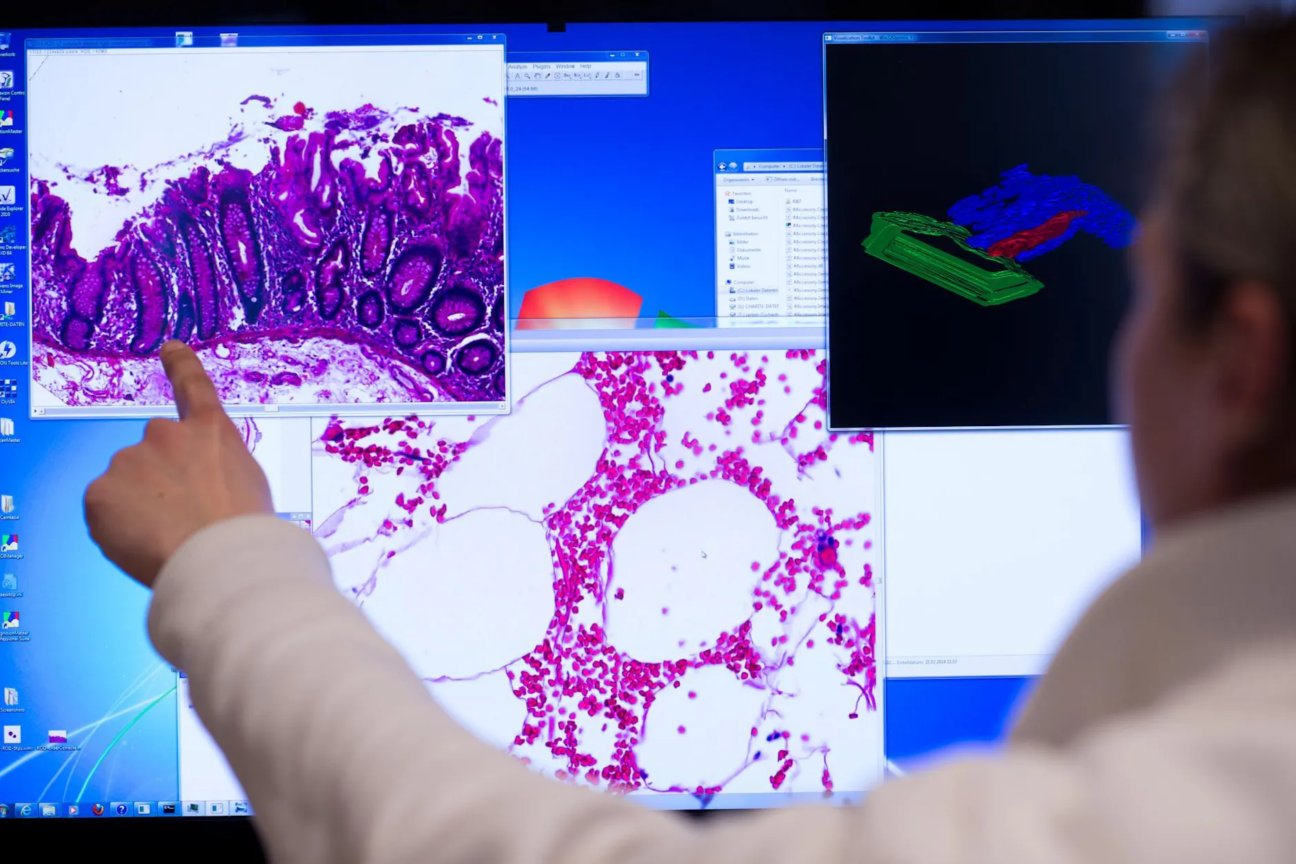 Ein Mitarbeiter der Pathologie zeigt an einem Computerbildschirm ein Stück Gewebe aus dem Dickdarm, das bei einer Operation entnommenen wurde.