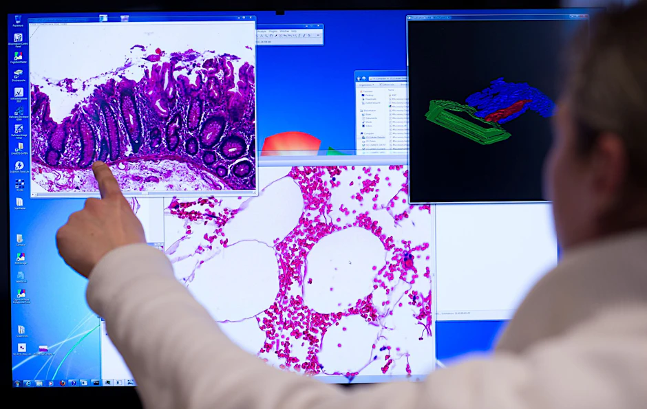 Ein Mitarbeiter der Pathologie zeigt an einem Computerbildschirm ein Stück Gewebe aus dem Dickdarm, das bei einer Operation entnommenen wurde. 