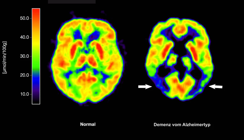 Durchbruch in der Behandlung von Alzheimer: EU lässt neues Medikament zu