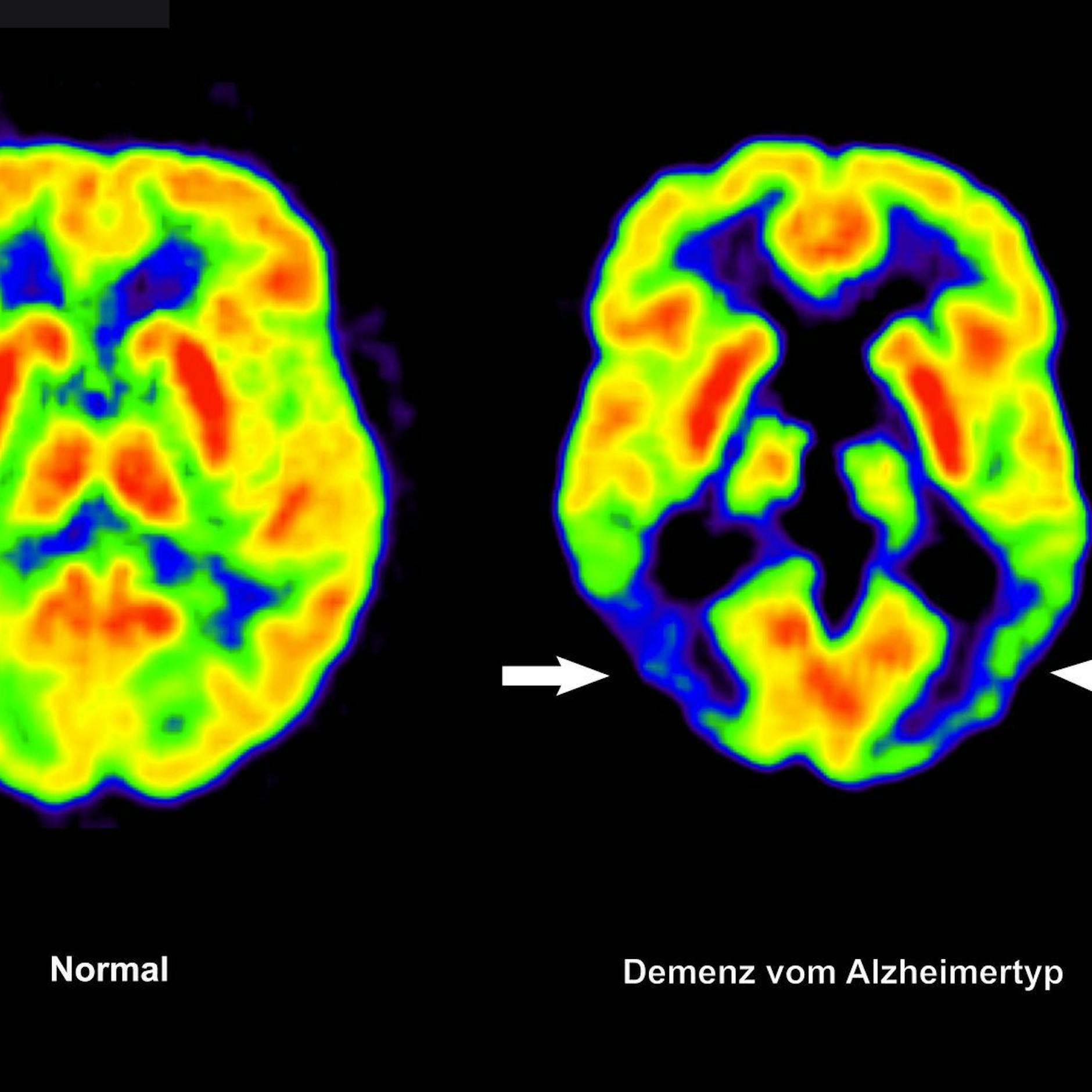 Image - Durchbruch in der Behandlung von Alzheimer: EU lässt neues Medikament zu