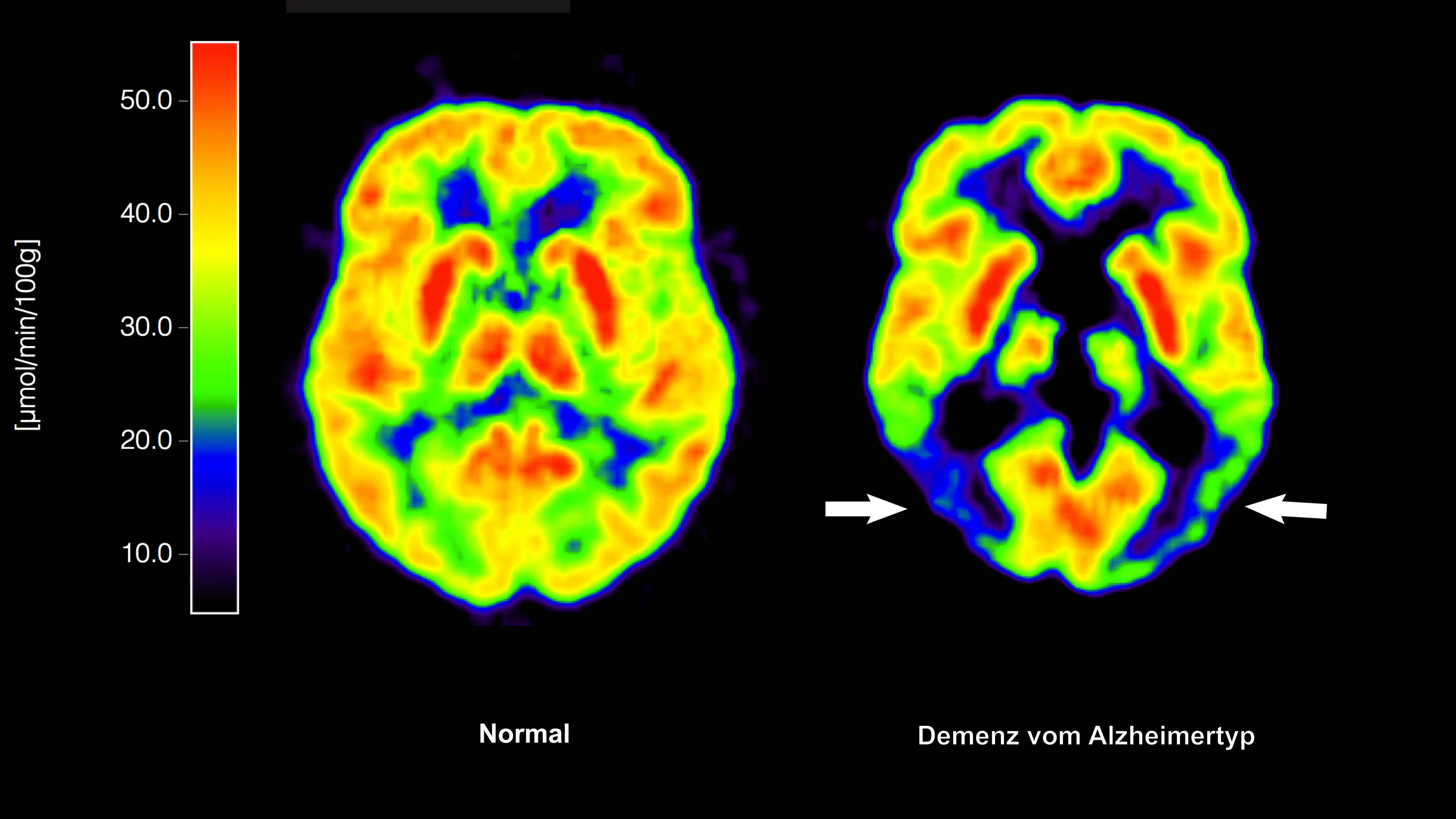 Die mit der Positronen-Emissions-Tomografie (PET) erstellte Abbildung zeigt die Gegenüberstellung zweier Gehirne – im gesunden Zustand (links) und mit Alzheimer-Krankheit.