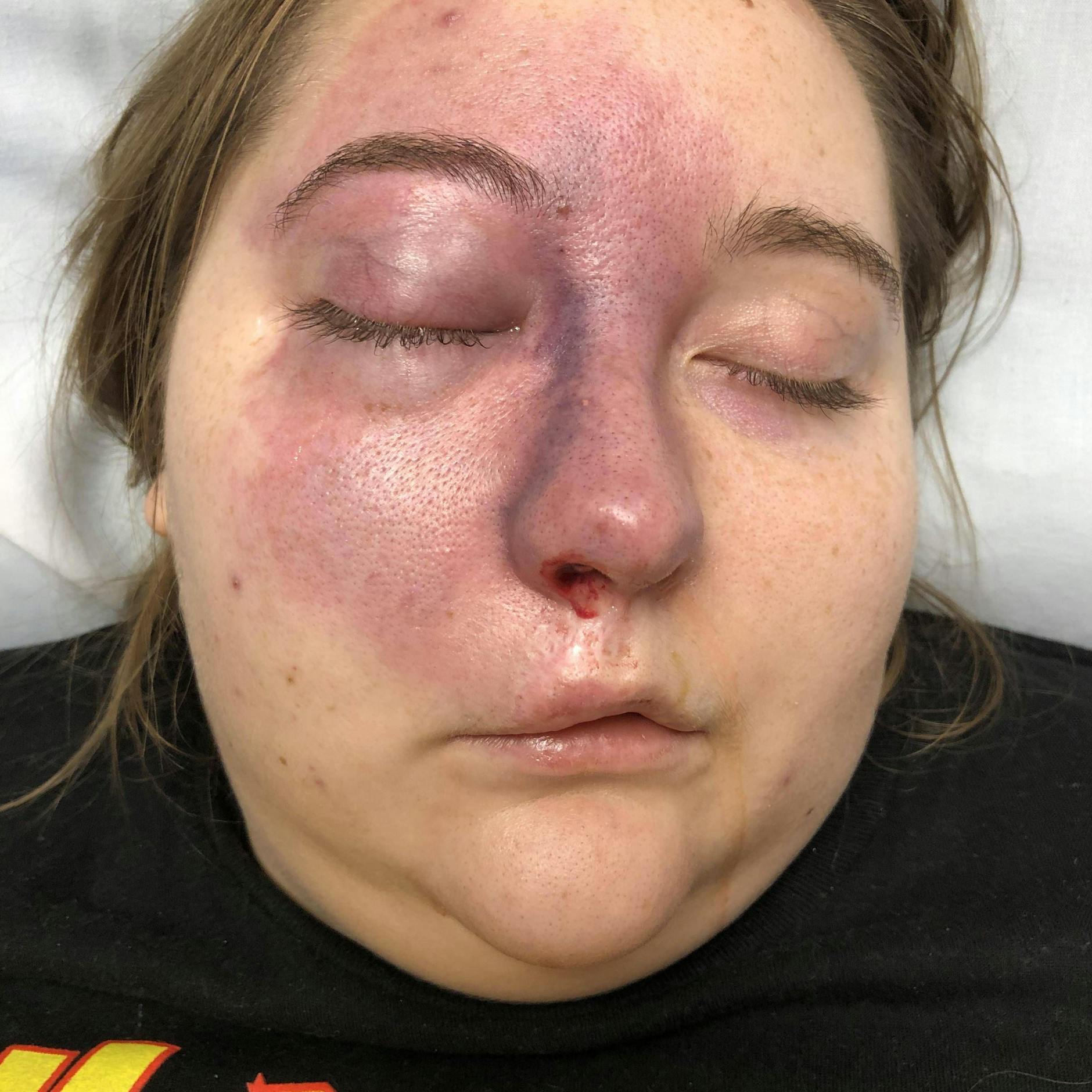 Im Gesicht bekam Jay Walker plötzlich einen riesigen violetten Fleck. Dann stellten die Ärzte fest, dass der Druck in ihren Augen extrem hoch war.