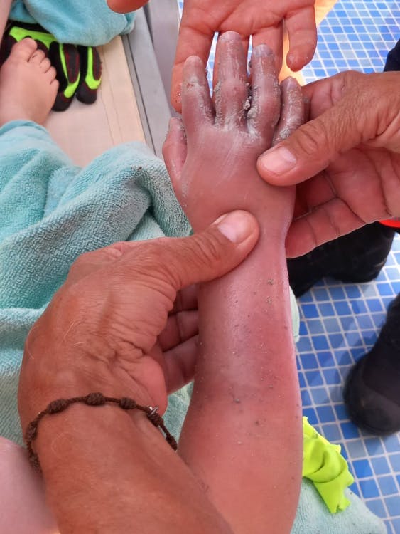 Geschwollen und lädiert, aber noch heile - die Hand des kleinen Jungen nach der Befreiung.