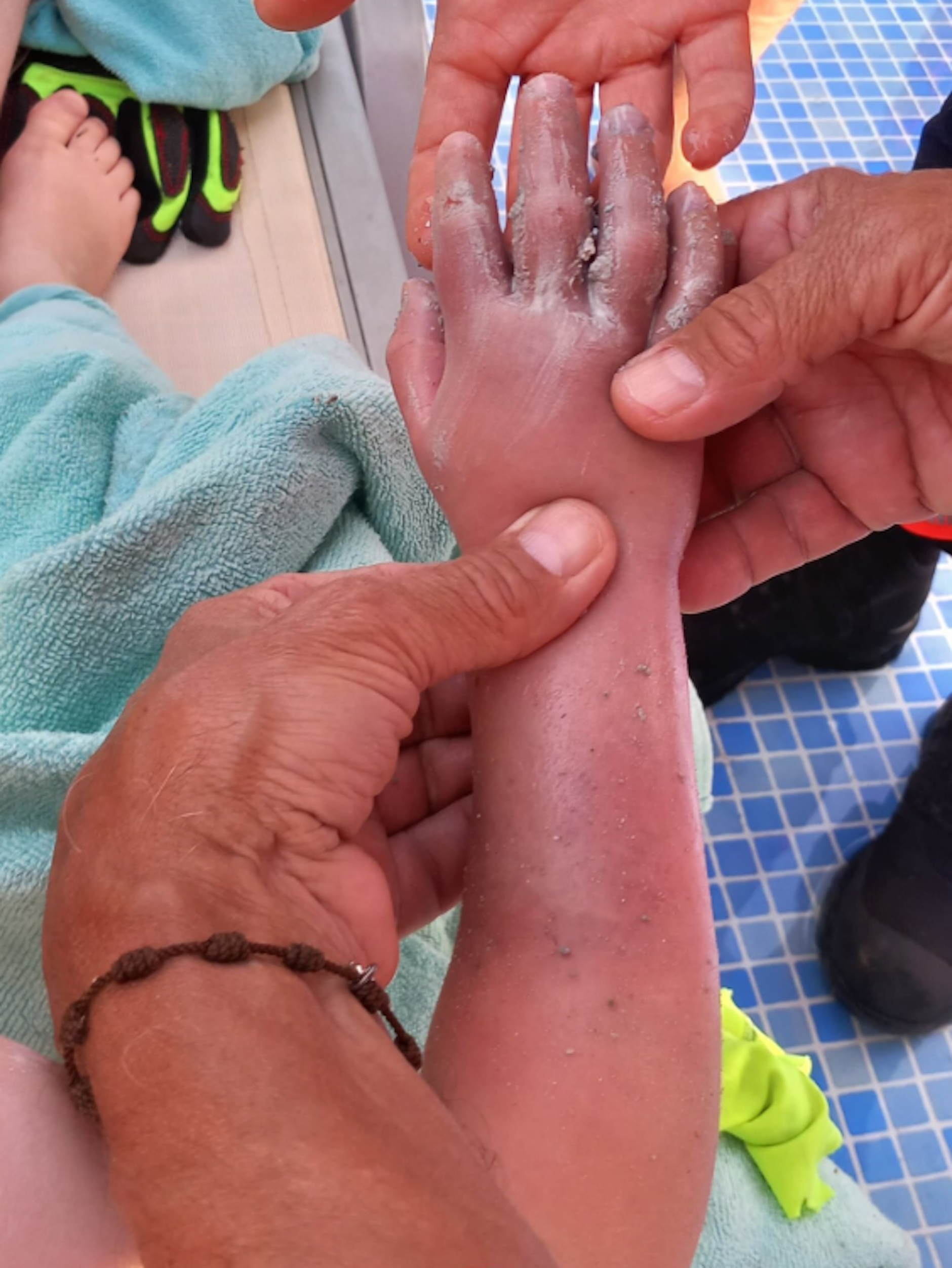 Geschwollen und lädiert, aber noch heile - die Hand des kleinen Jungen nach der Befreiung.