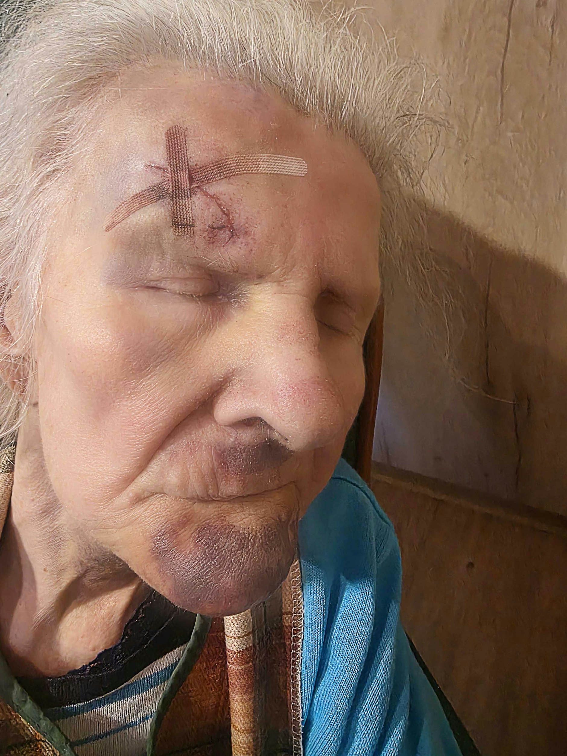 Nach dem Sturz hatte Anna K. starke Blutergüsse im Gesicht.