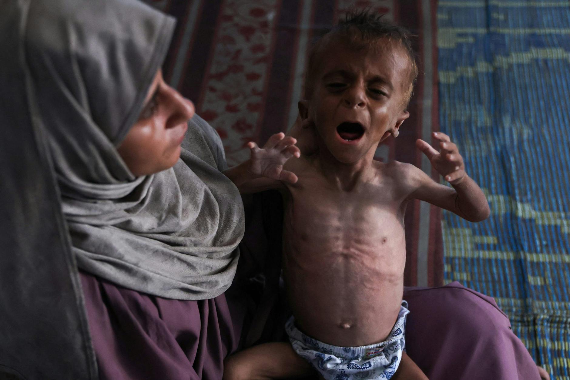 Bilder des Grauens: Ein ausgehungertes, 18 Monate altes Kind im Gazastreifen kämpft ums Überleben.